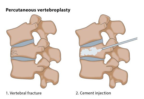 Diagram of Vertebroplasty