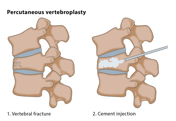 Spinal Compression Fractures: A Comprehensive Overview