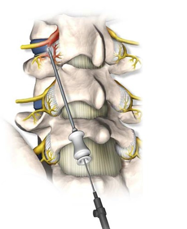 Lumbar Rhizotomy Procedure